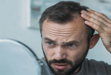 hairloss